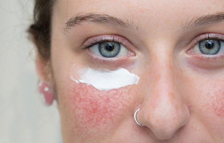 rosacea-tratamiento